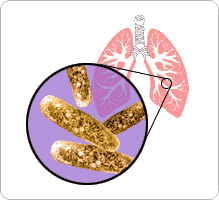 tuberculose